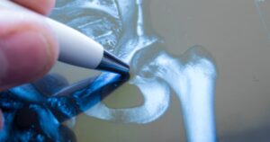 Why You Should Not Ignore Hip Pain After a Car Crash in Minneapolis