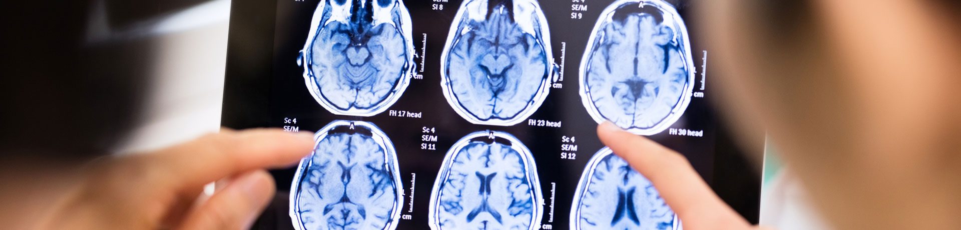 Minneapolis Traumatic Brain Injury Lawyers